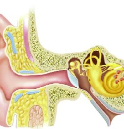 BPPV
